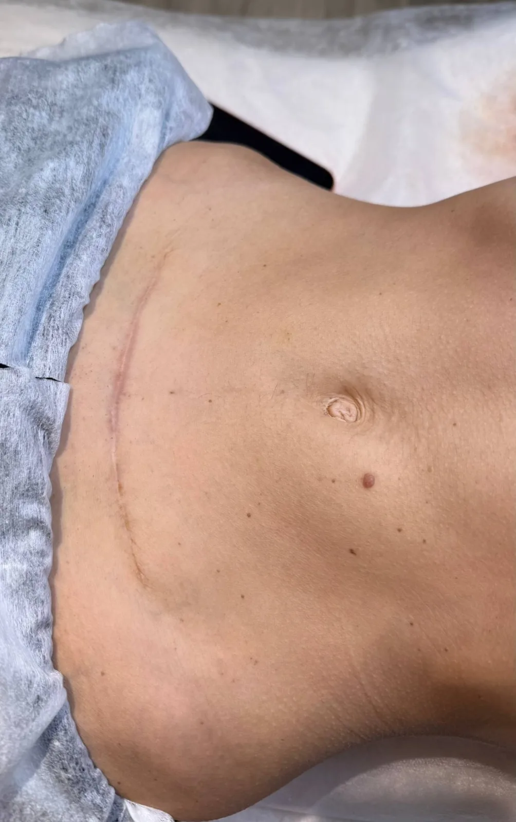 Cicatriz de cesárea ya sanada en la consulta