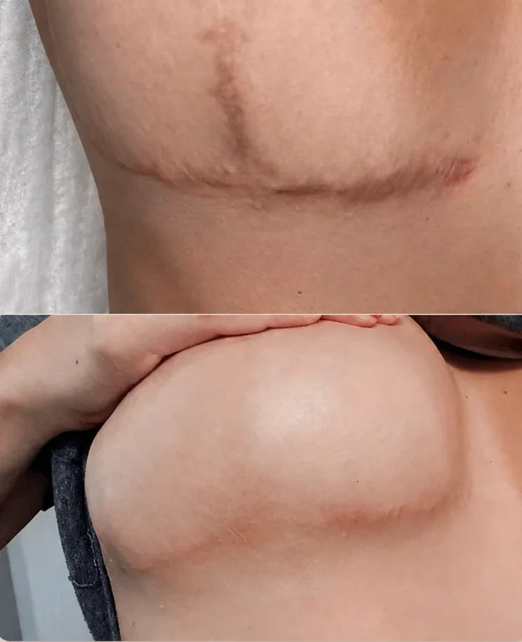 Camuflaje de cicatriz en el pecho, antes y después